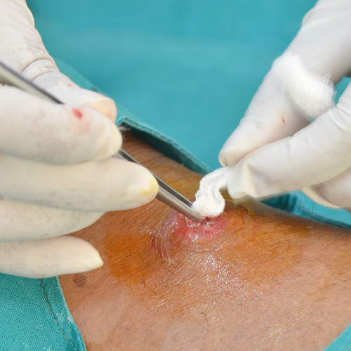 Drenagem de abscesso cutâneo